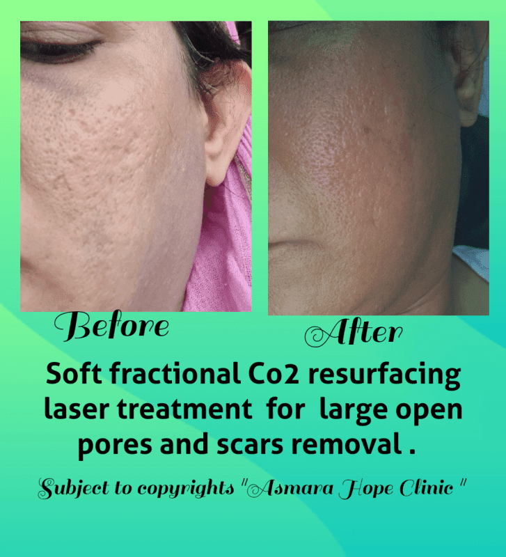 CO2 Laser Skin Resurfacing Glasgow